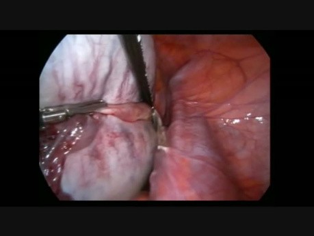 Traitement laparoscopique d'un gros tératome