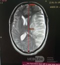 Craniectomie Décompressive