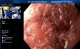 Saignement de Varices œsophagiennes
