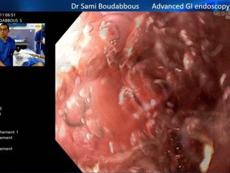 Saignement de Varices œsophagiennes