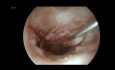 Tympanoplastie et Ossiculoplastie Endoscopiques pour l'Otite Moyenne Chronique Suppurée