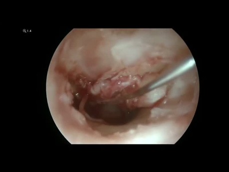 Tympanoplastie et Ossiculoplastie Endoscopiques pour l'Otite Moyenne Chronique Suppurée
