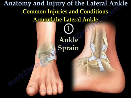 Anatomie et blessures de la cheville latérale