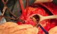 Valve Aortique Biologique dans la Chirurgie Valvulaire avec TAVI
