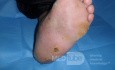 L'ostéoarthropathie diabétique  (OD / le pied de Charcot) avec d'un ulcère plantaire