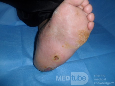 L'ostéoarthropathie diabétique  (OD / le pied de Charcot) avec d'un ulcère plantaire