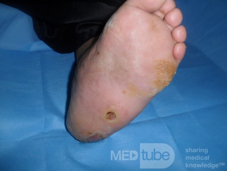 L'ostéoarthropathie diabétique  (OD / le pied de Charcot) avec d'un ulcère plantaire