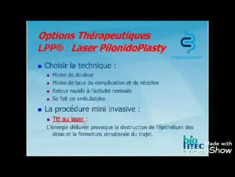 Traitement Laser du Sinus Pilonidal