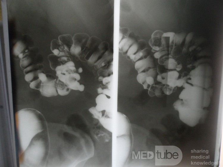 Les diverticules coliques.