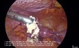 Morcellation confinée versus morcellation non confinée de fibrome