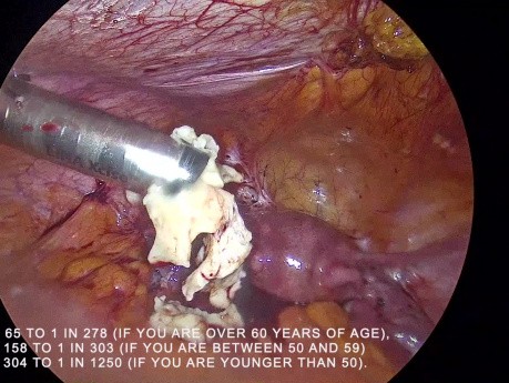 Morcellation confinée versus morcellation non confinée de fibrome