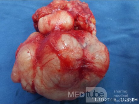 L' Adénofibrome géant du sein