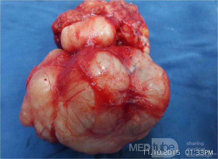 L' Adénofibrome géant du sein