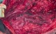 Parotidectomie