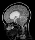  Ventriculostomie endoscopique du troisième ventricule dans un cas bénin du syndrome d'Aicardi avec hydrocéphalie obstructive et malformation de Chiari de type 1.