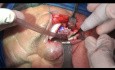 Reconstruction primaire avec implant PEEK d'une malformation veineuse intra-osseuse du bord orbitaire latéral