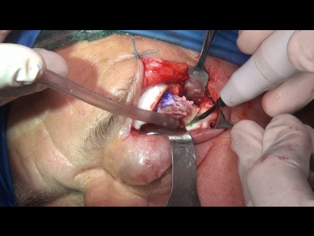 Reconstruction primaire avec implant PEEK d'une malformation veineuse intra-osseuse du bord orbitaire latéral