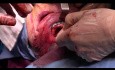 Double fracture de la mandibule atrophique