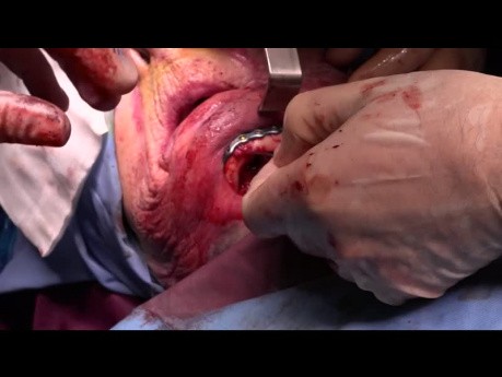 Double fracture de la mandibule atrophique