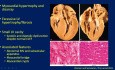 Évaluation Echocardiographique de la Cardiomyopathie Hypertrophique (CMH)