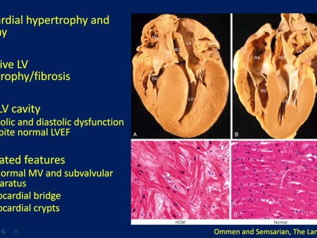 Évaluation Echocardiographique de la Cardiomyopathie Hypertrophique (CMH)