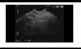 Écho-endoscopie d'une sténose papillaire