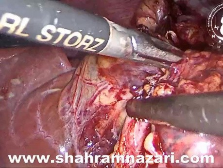 Cholécystectomie laparoscopique/Artère hépatique droite accessoire
