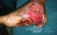 L'ulcère du pied diabétique, une infection du pied. 1