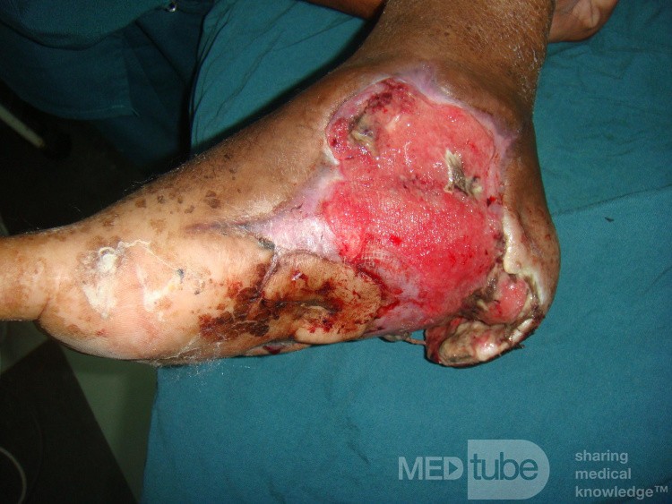 L'ulcère du pied diabétique, une infection du pied. 1