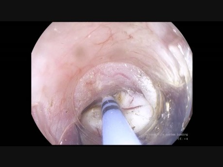 La dissection sous muqueuse par la méthode du tunnel - la jonction œsogastrique (STER )