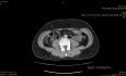 Résection laparoscopique de la masse para-aortique
