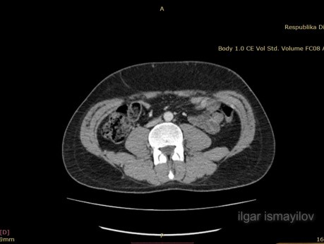 Résection laparoscopique de la masse para-aortique