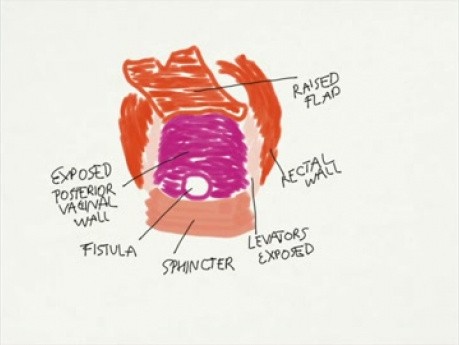 Réparation de la fistule recto-vaginale traumatique récurrente