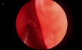 Chirurgie Endoscopique Complète Sinusienne Droite 