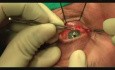 Abord Trans-Conjonctival, Mise en Place de Prothèse, Fracture Type Blow-Out, Traitement, Chirurgie Maxillo-Faciale