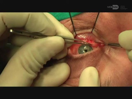 Abord Trans-Conjonctival, Mise en Place de Prothèse, Fracture Type Blow-Out, Traitement, Chirurgie Maxillo-Faciale