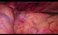 La surrenalectomie laparoscopique transpéritonéale du côté gauche pour le métastase du cancer du poumon non à petites cellules (CPNPC)