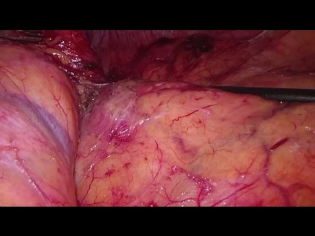 La surrenalectomie laparoscopique transpéritonéale du côté gauche pour le métastase du cancer du poumon non à petites cellules (CPNPC)