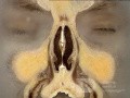 Anatomie coronale du nez et des sinus paranasaux: tranche 2