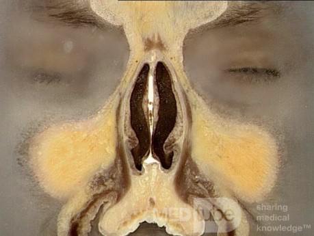 Anatomie coronale du nez et des sinus paranasaux: tranche 2