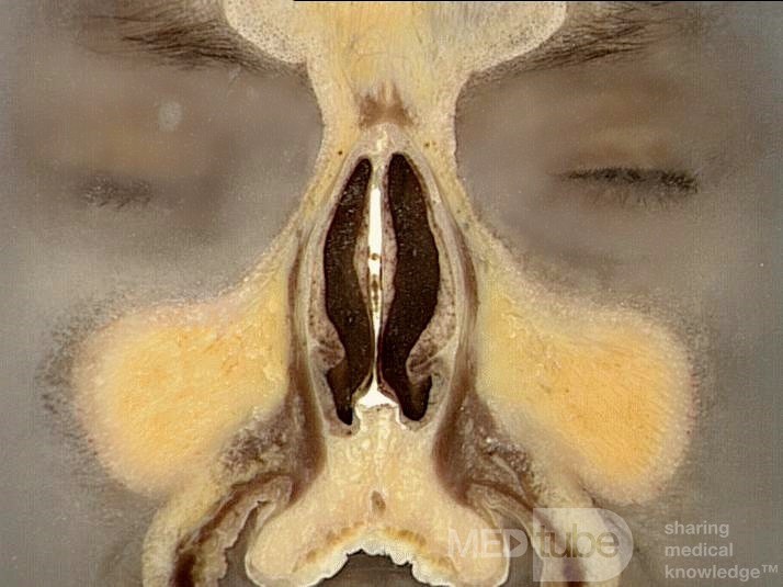 Anatomie coronale du nez et des sinus paranasaux: tranche 2