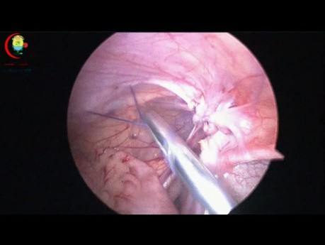 Nœud intracorporel à instrument unique ou nœud de Shalaby Ismail dans la réparation d'une hernie congénitale chez un nourrisson de 11 mois