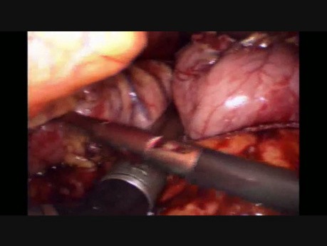 Blocage de l'agrafeuse lors d'une gastrectomie en manchon
