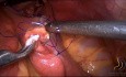Gastrectomie Subtotale Laparoscopique (Curage Ganglionnaire D2)
