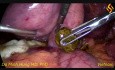 Cholécystectomie laparoscopique, cholédochoscopie et extraction des calculs du conduit cholédoque
