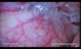 Cure de hernie inguinale par voie laparoscopique: Trans-Abdomino-Pré-Péritonéale (TAPP).