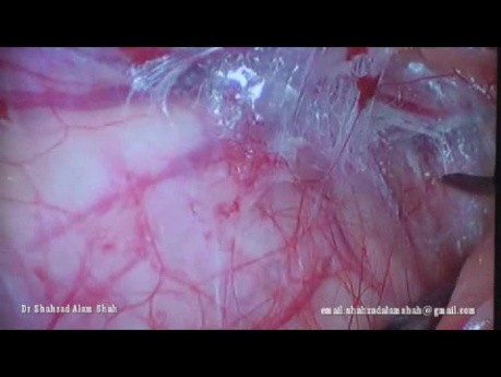 Cure de hernie inguinale par voie laparoscopique: Trans-Abdomino-Pré-Péritonéale (TAPP).