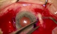 Vitrectomie 25G Pars Plana + Implantation de LIO Soleko Carlevale utilisant la technique «Scleral Pocket»