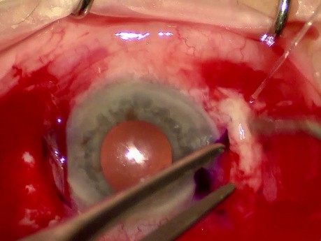 Vitrectomie 25G Pars Plana + Implantation de LIO Soleko Carlevale utilisant la technique «Scleral Pocket»
