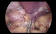 Gastrectomie Sleeve Laparoscopique